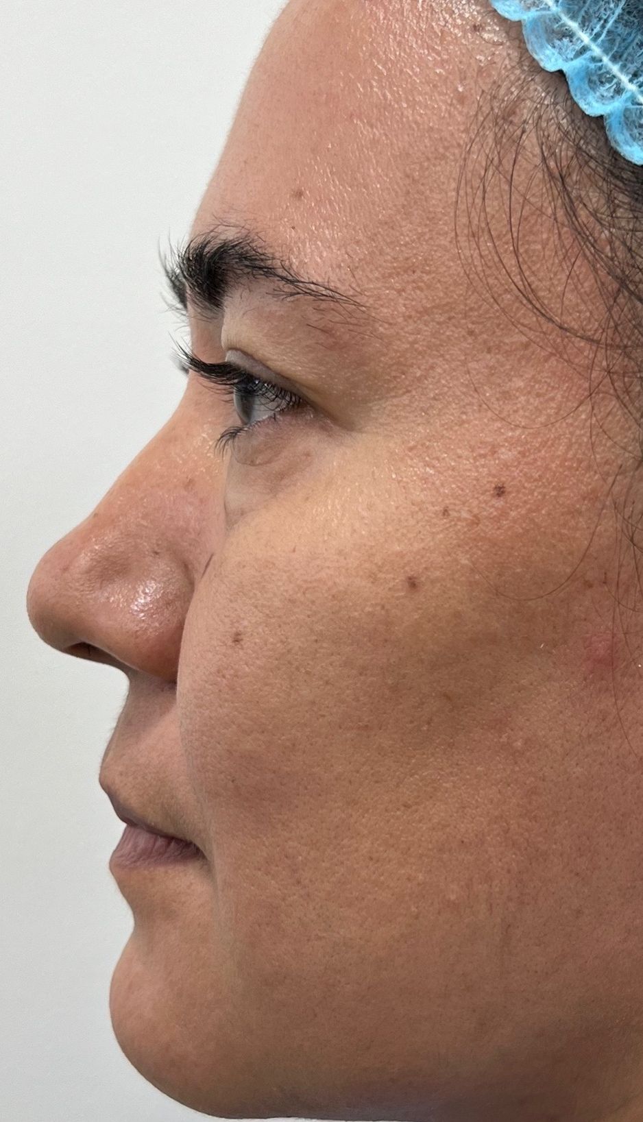 Blefaroplastia o Cirugía de Párpados – antes del procedimiento | Dr. Diego Castañeda, cirujano plástico en Neiva