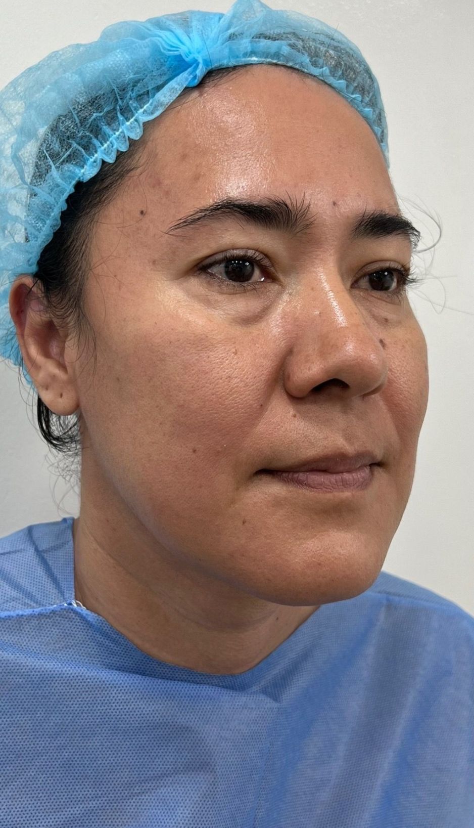Blefaroplastia o Cirugía de Párpados – antes del procedimiento | Dr. Diego Castañeda, cirujano plástico en Neiva