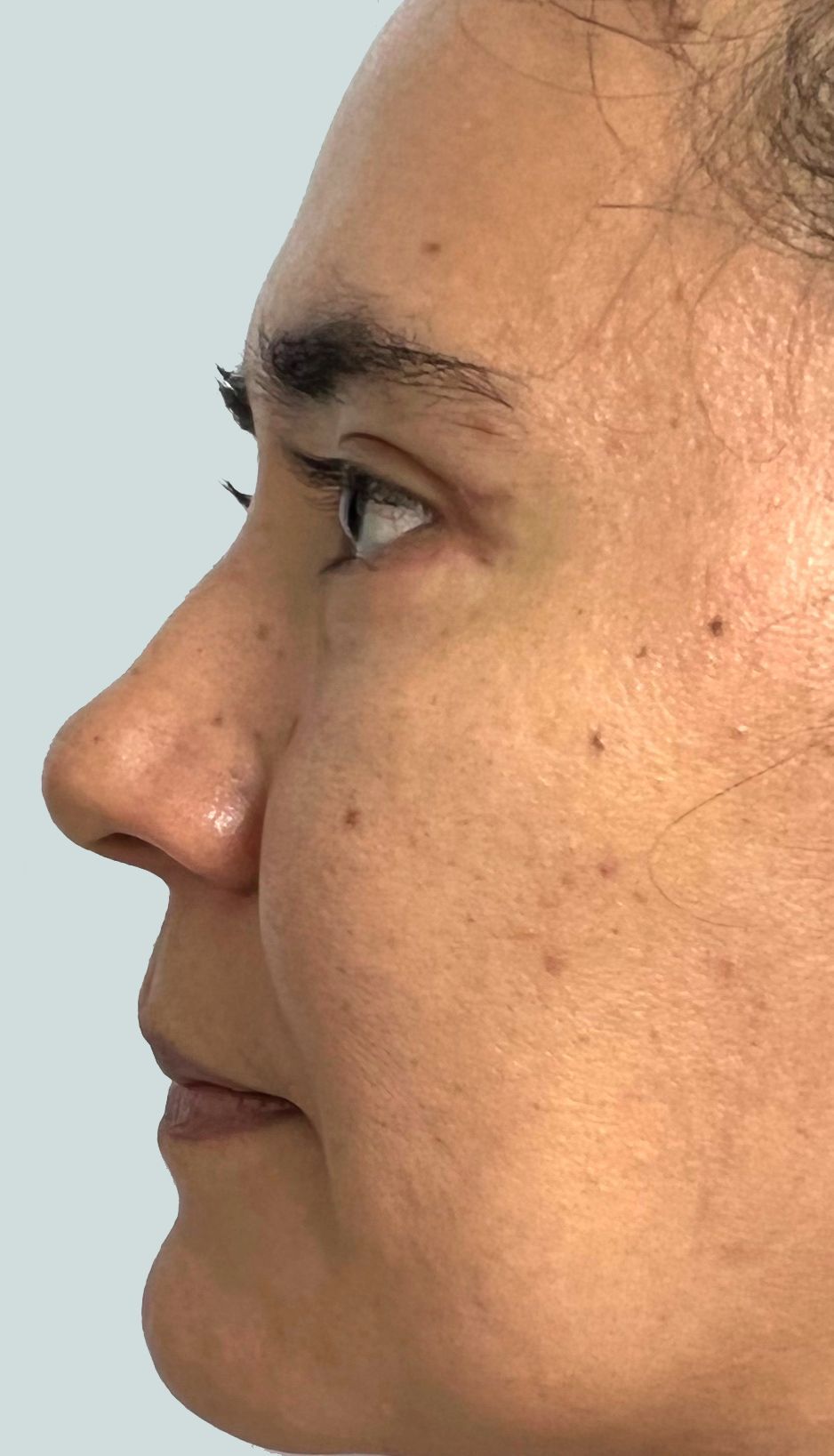 Blefaroplastia o Cirugía de Párpados – después del procedimiento | Dr. Diego Castañeda, cirujano plástico en Neiva