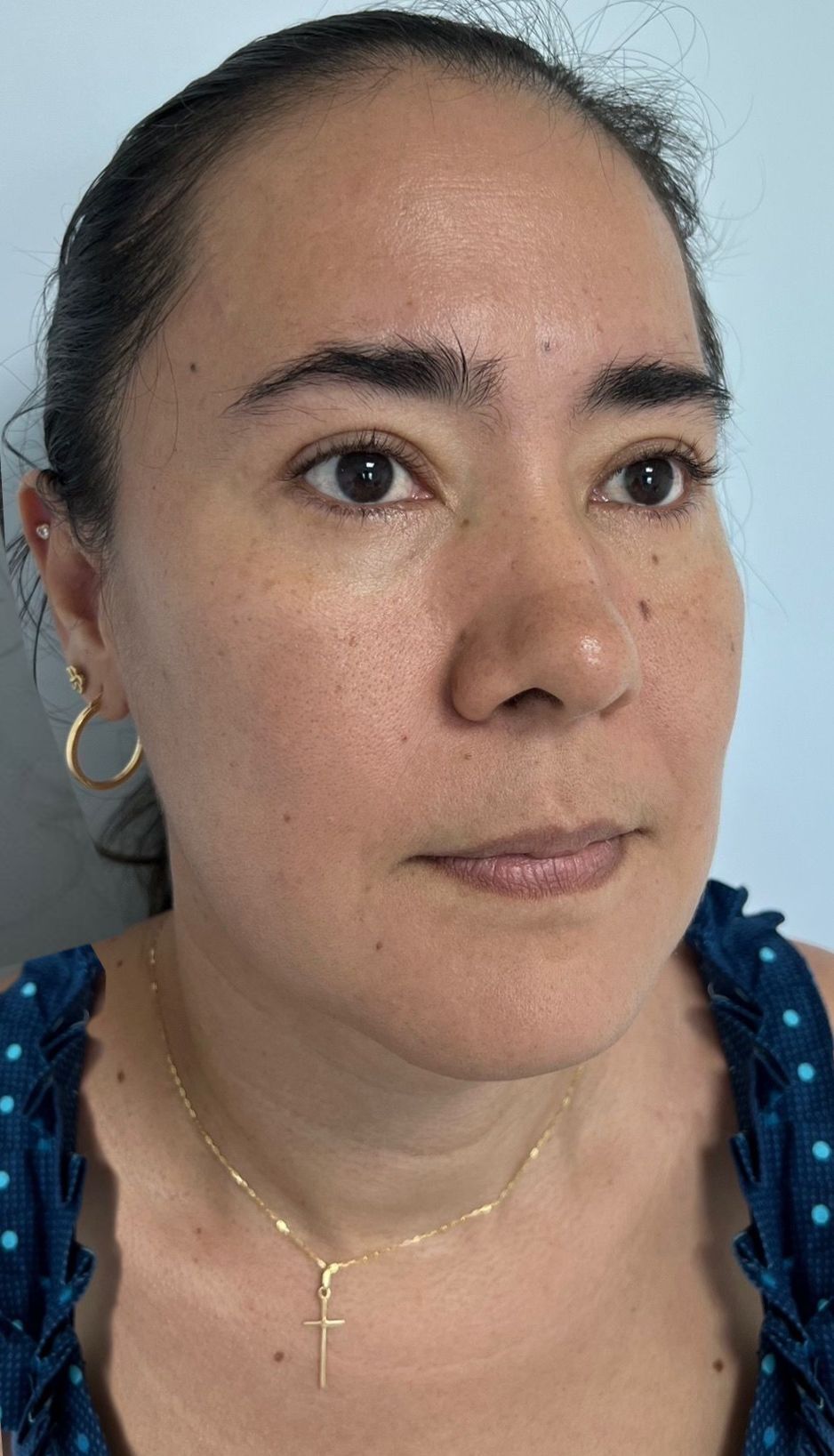 Blefaroplastia o Cirugía de Párpados – después del procedimiento | Dr. Diego Castañeda, cirujano plástico en Neiva