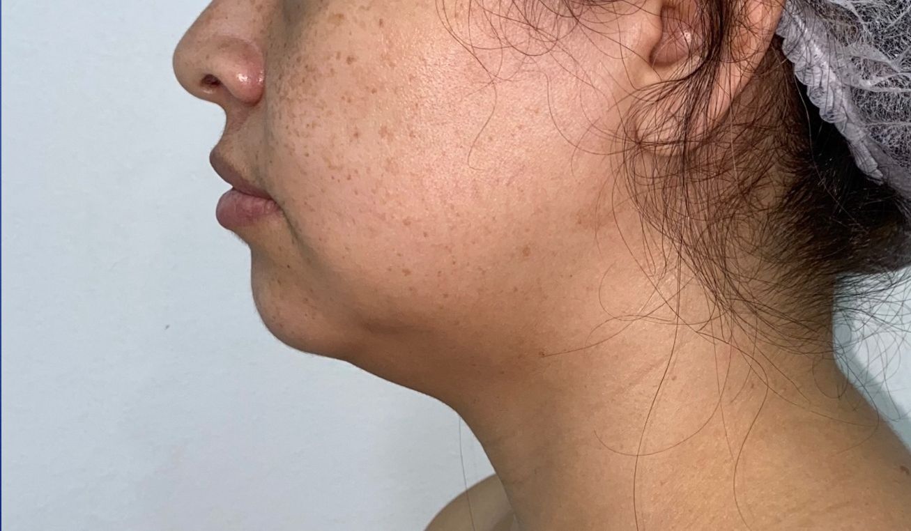Ritidoplastia o lifting facial – antes del procedimiento | Dr. Diego Castañeda, cirujano plástico en Neiva