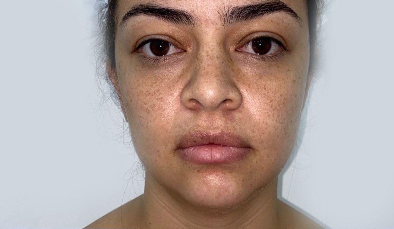 Ritidoplastia o lifting facial – antes del procedimiento | Dr. Diego Castañeda, cirujano plástico en Neiva