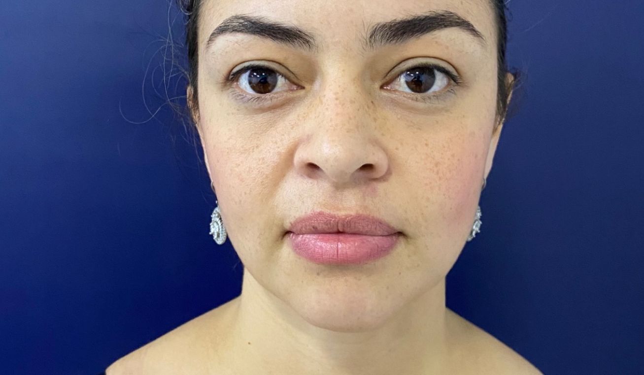 Ritidoplastia o lifting facial – después del procedimiento | Dr. Diego Castañeda, cirujano plástico en Neiva