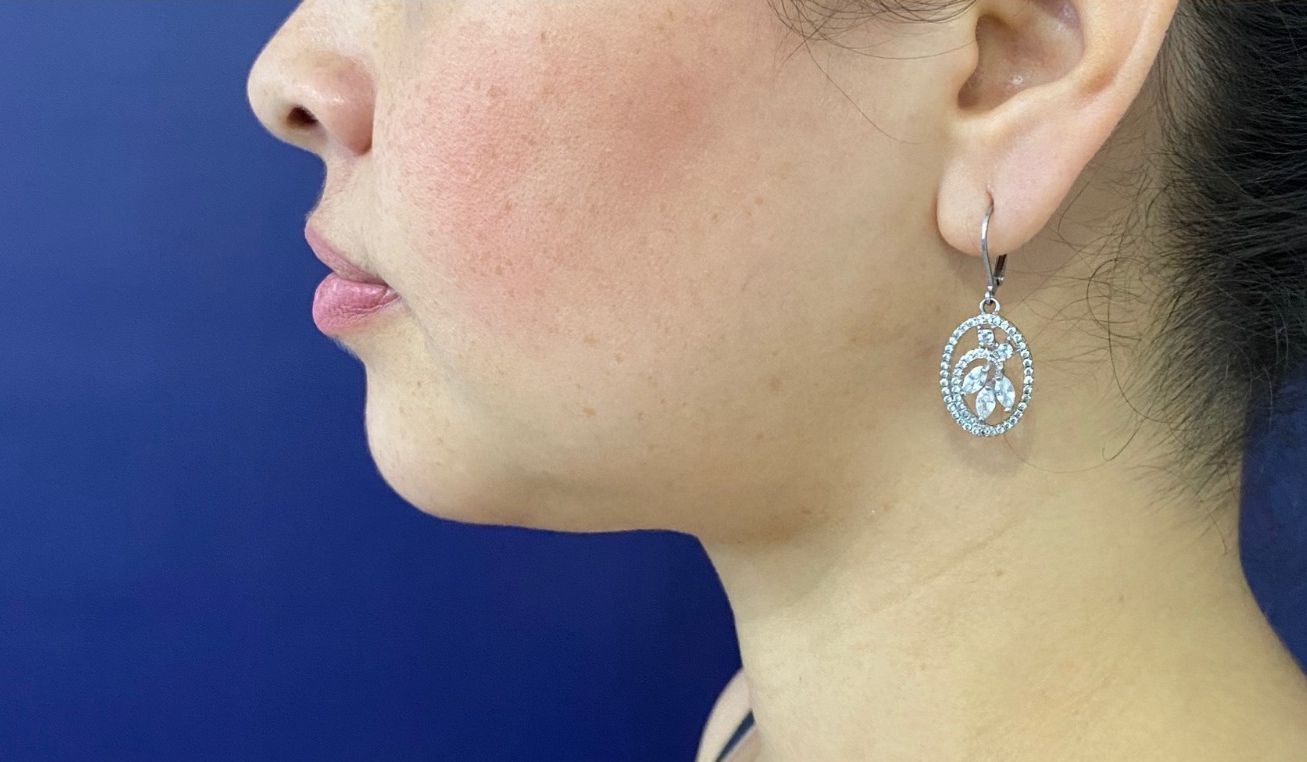 Ritidoplastia o lifting facial – después del procedimiento | Dr. Diego Castañeda, cirujano plástico en Neiva