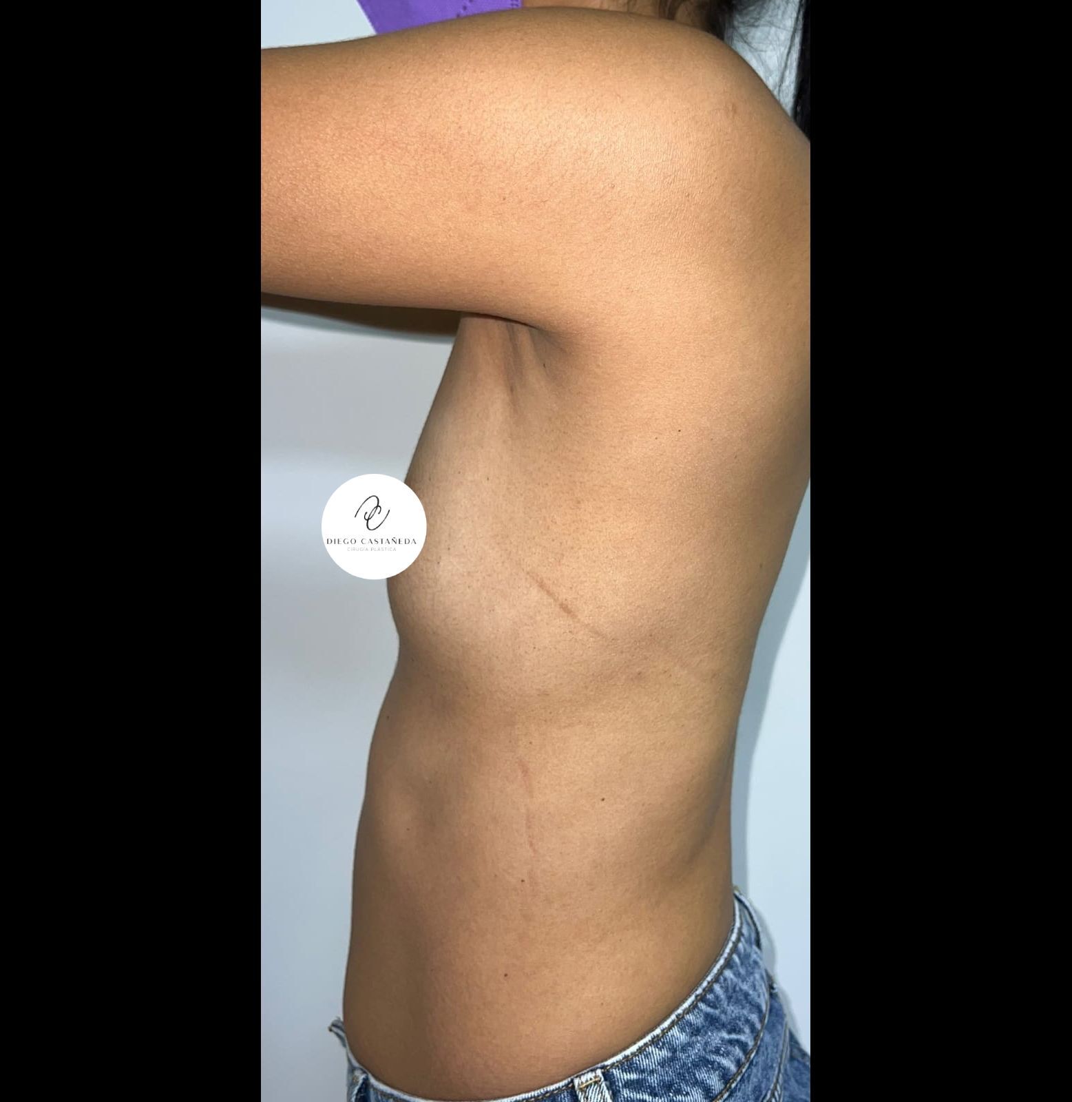 Mamoplastia – antes del procedimiento | Dr. Diego Castañeda, cirujano plástico en Neiva