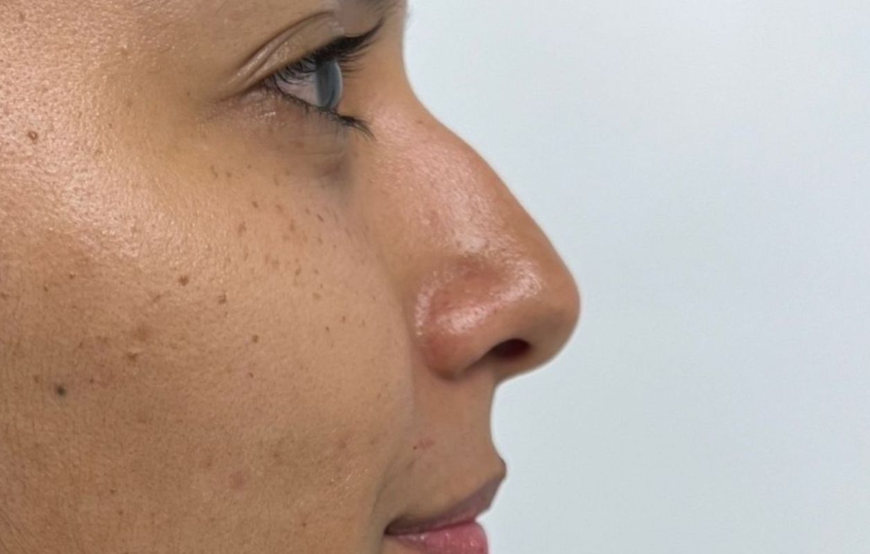 Rinoplastia Estética, Estructural y Funcional – antes del procedimiento | Dr. Diego Castañeda, cirujano plástico en Neiva