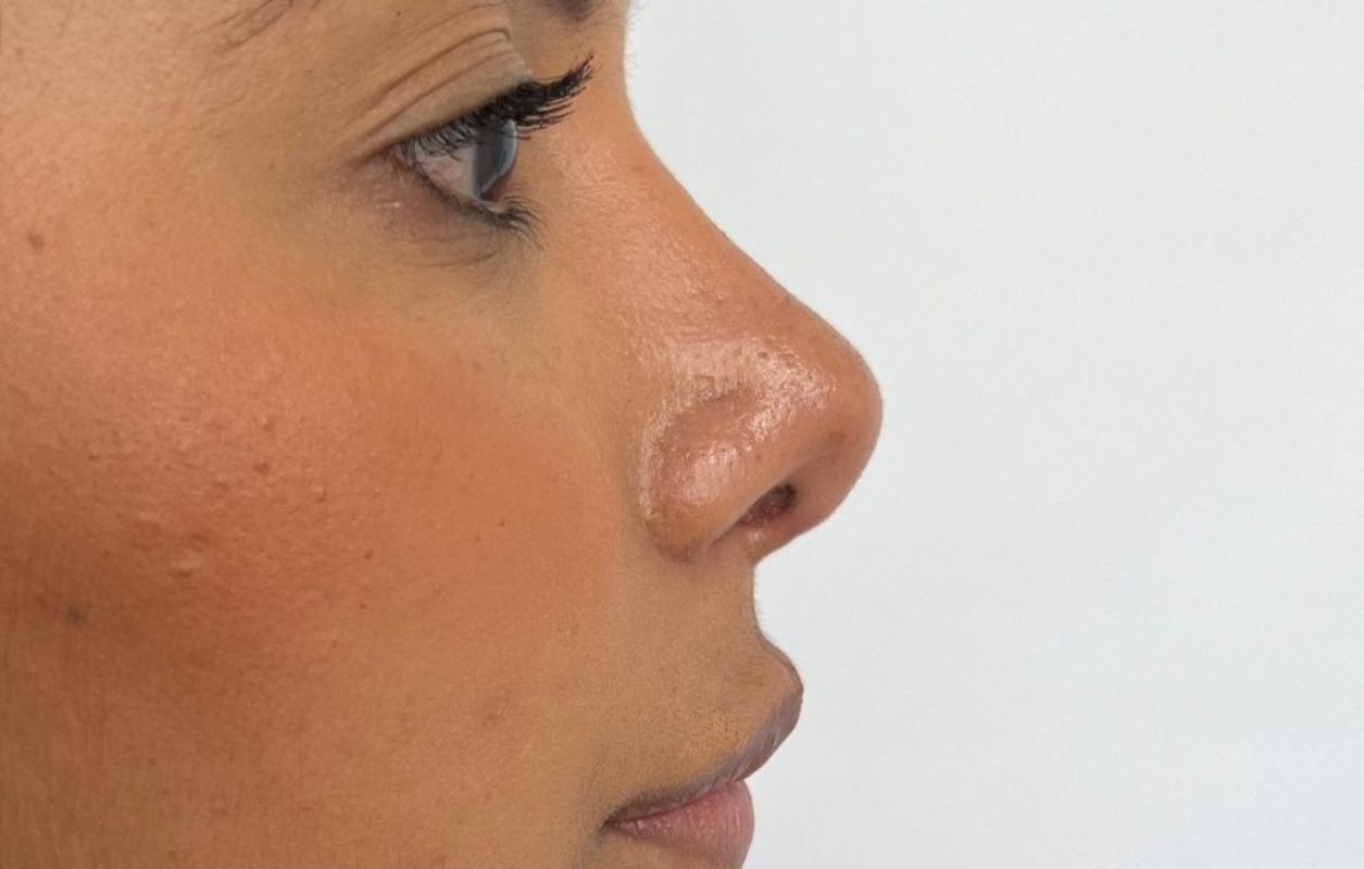 Rinoplastia Estética, Estructural y Funcional – después del procedimiento | Dr. Diego Castañeda, cirujano plástico en Neiva