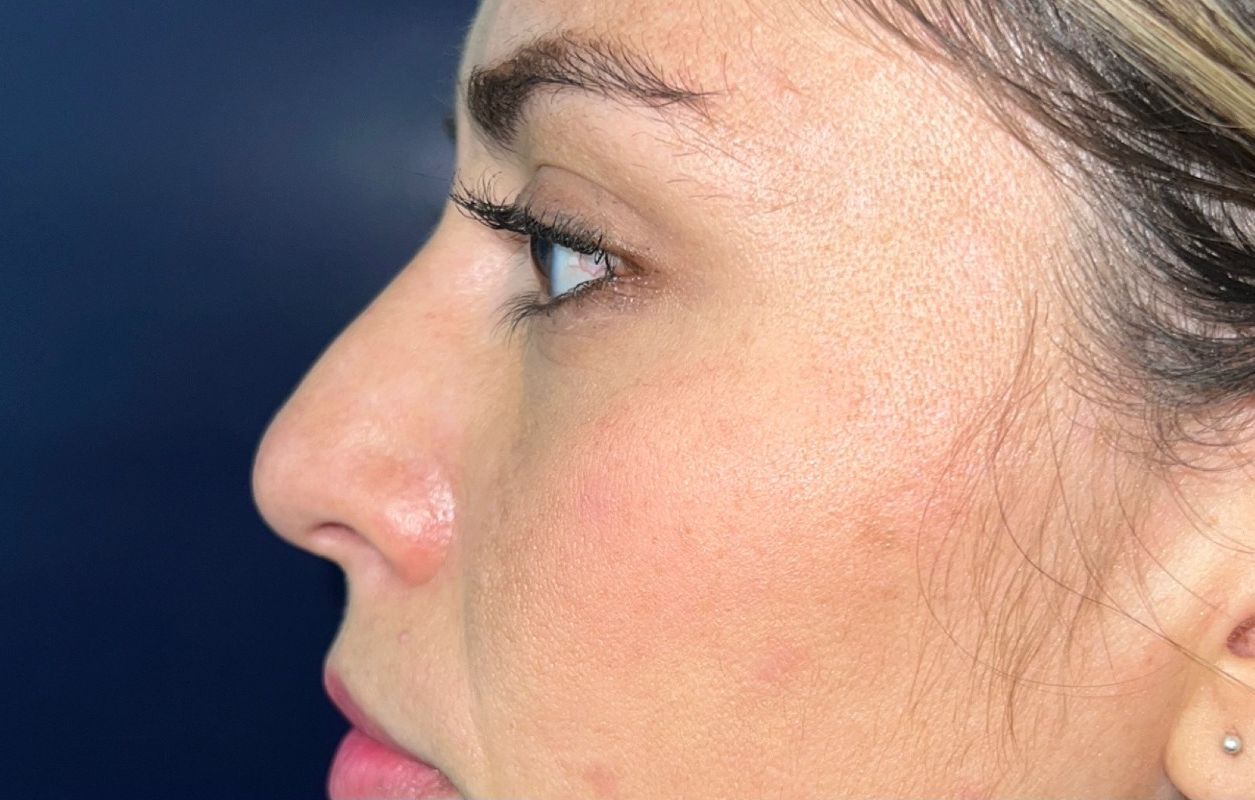 Rinoplastia Estética, Estructural y Funcional – antes del procedimiento | Dr. Diego Castañeda, cirujano plástico en Neiva