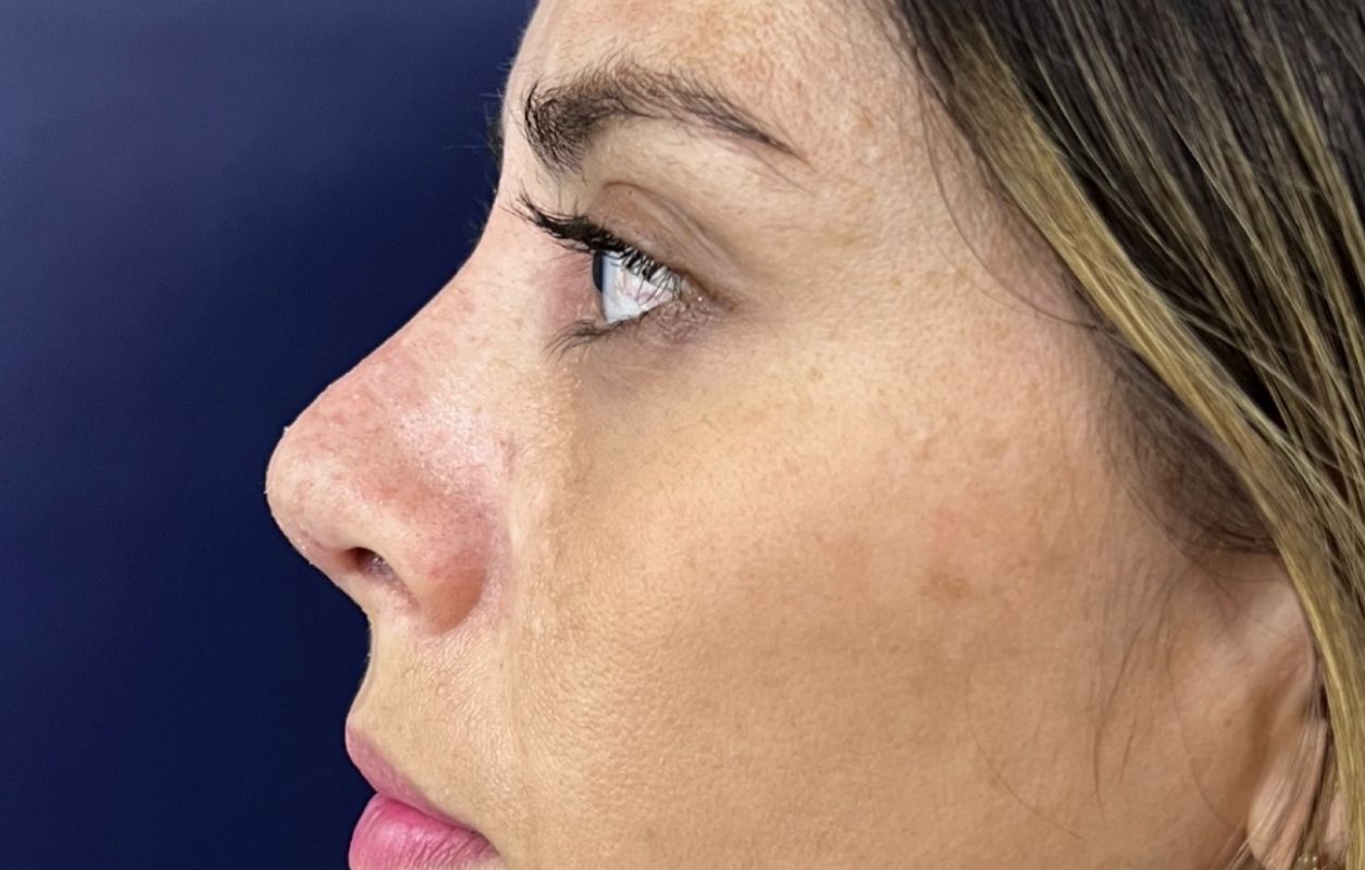 Rinoplastia Estética, Estructural y Funcional – después del procedimiento | Dr. Diego Castañeda, cirujano plástico en Neiva