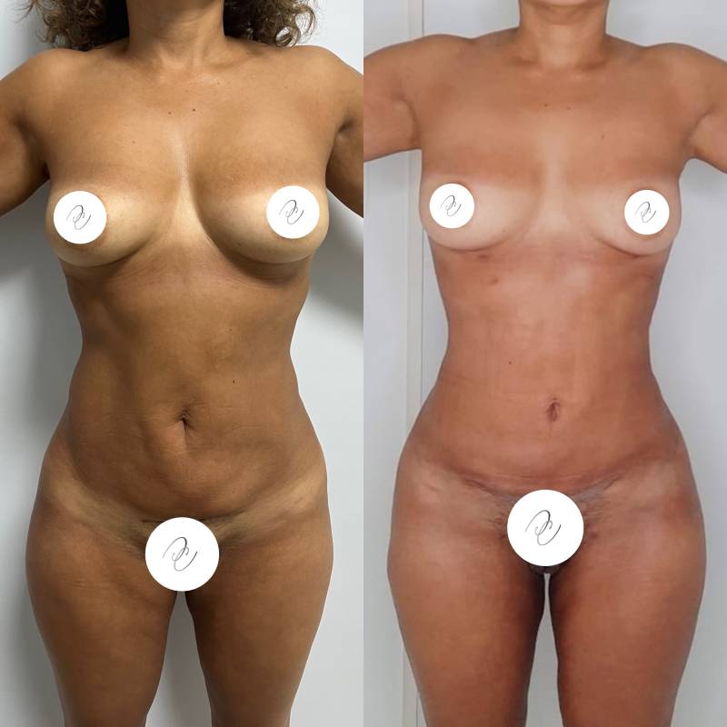 Lipoescultura o Liposucción – foto 1 | Dr. Diego Castañeda, cirujano plástico en Neiva