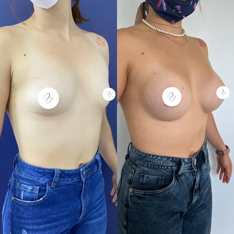 Mamoplastia – foto 6 | Dr. Diego Castañeda, cirujano plástico en Neiva