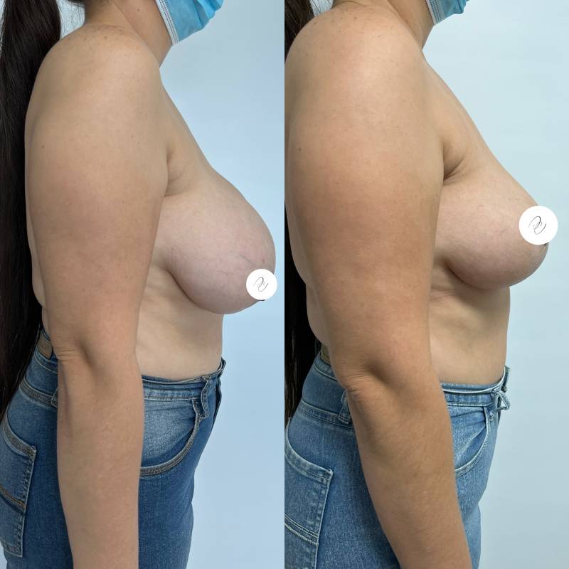 Pexia o Levantamiento Mamario – foto 3 | Dr. Diego Castañeda, cirujano plástico en Neiva