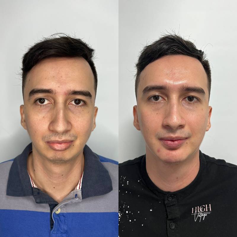 Mentoplastia – foto 1 | Dr. Diego Castañeda, cirujano plástico en Neiva