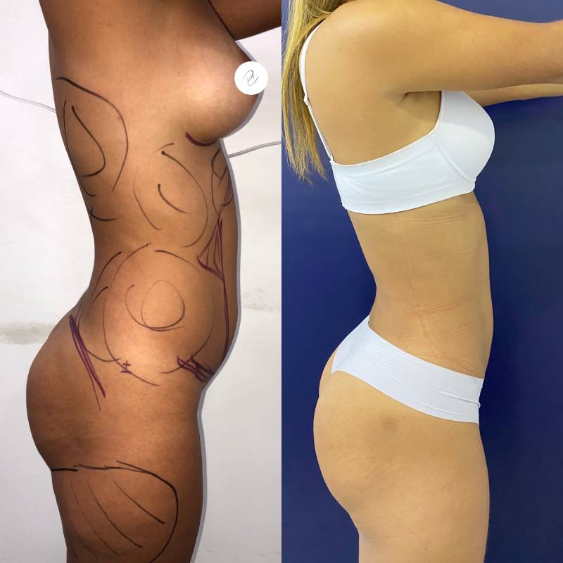Lipoescultura o Liposucción – foto 2 | Dr. Diego Castañeda, cirujano plástico en Neiva