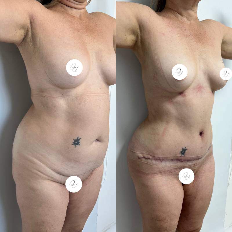 Abdominoplastia o lipectomía – foto 1 | Dr. Diego Castañeda, cirujano plástico en Neiva