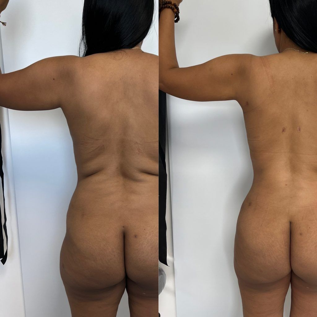 Lipoescultura o Liposucción – foto 6 | Dr. Diego Castañeda, cirujano plástico en Neiva
