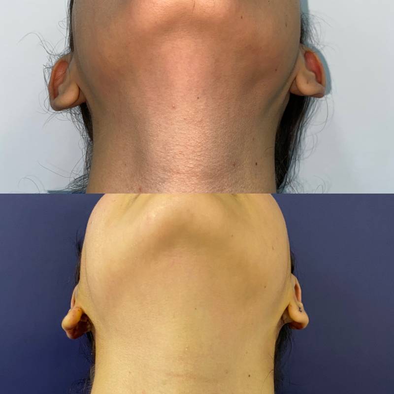 Otoplastia o Cirugía de Orejas – foto 4 | Dr. Diego Castañeda, cirujano plástico en Neiva
