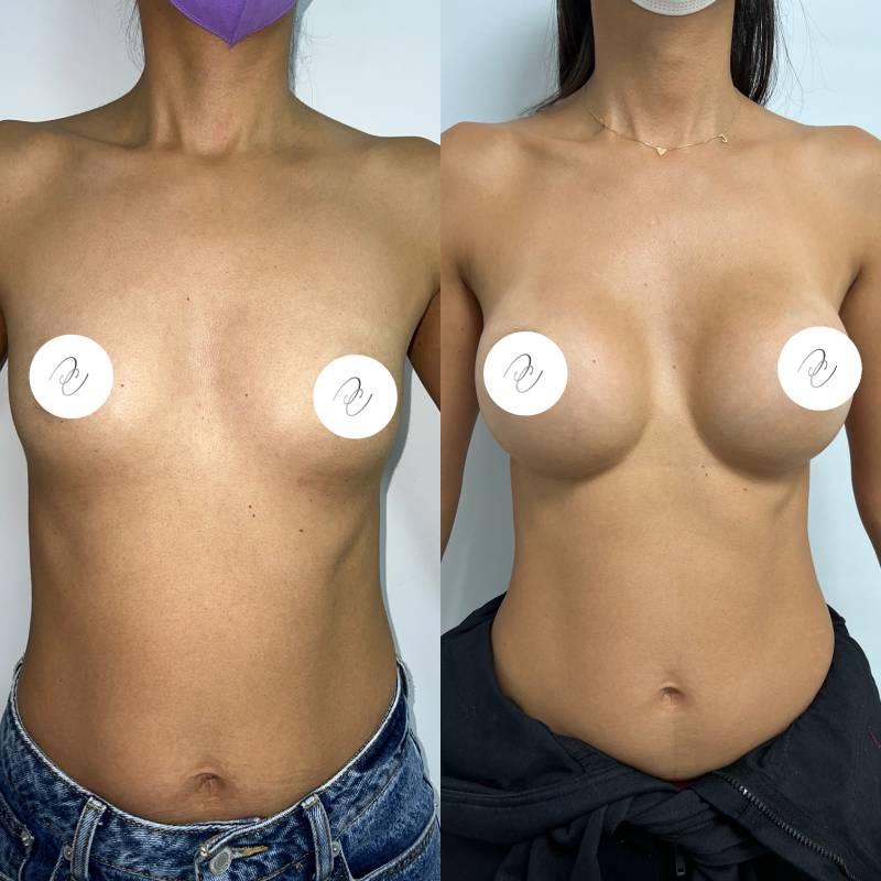 Mamoplastia – foto 3 | Dr. Diego Castañeda, cirujano plástico en Neiva