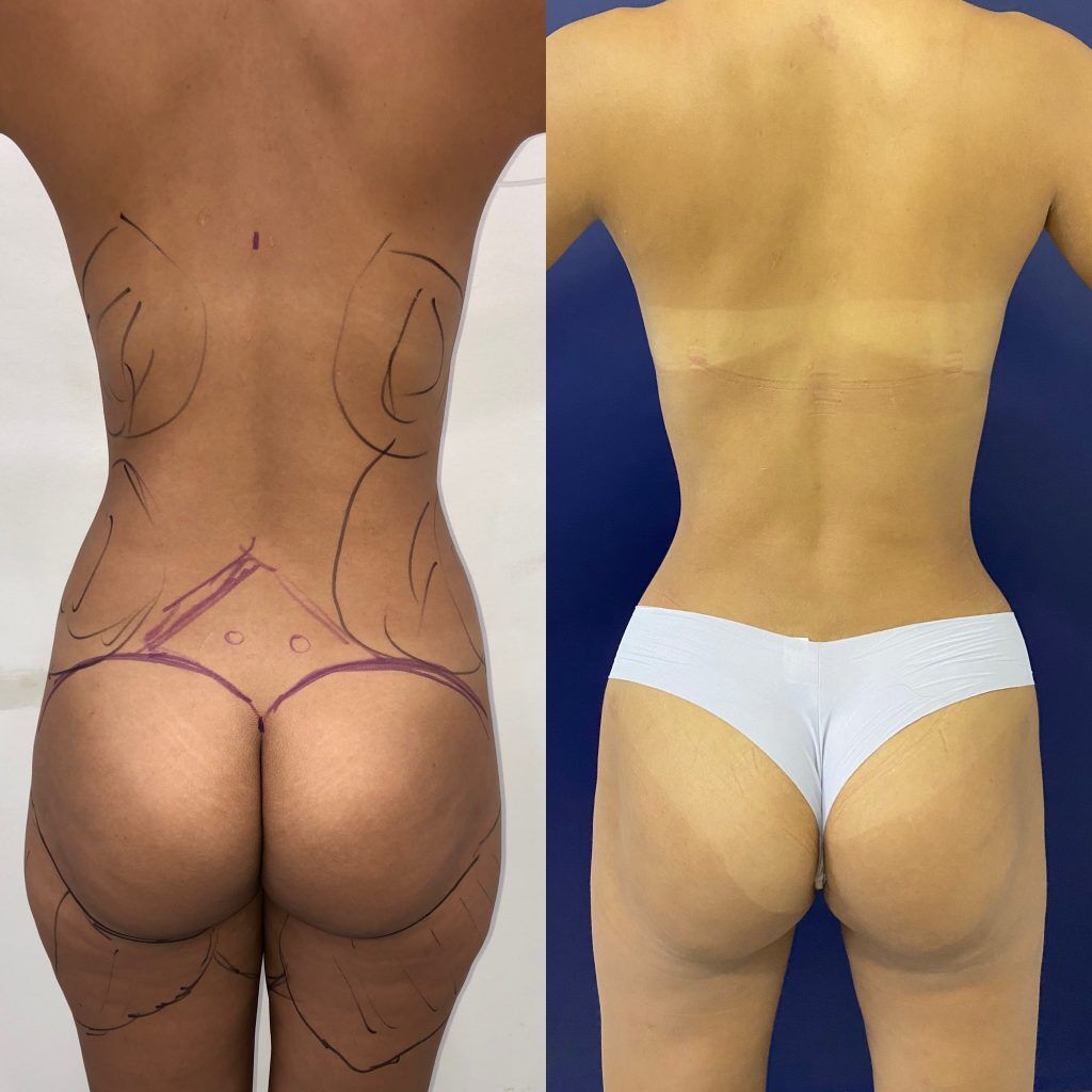 Lipoescultura o Liposucción – foto 4 | Dr. Diego Castañeda, cirujano plástico en Neiva