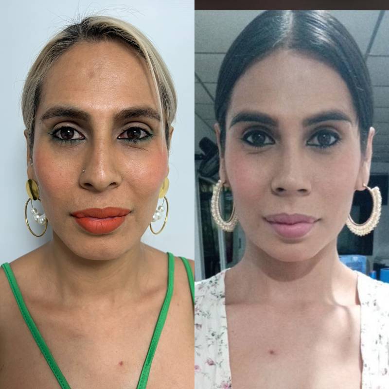 Feminización facial – foto 1 | Dr. Diego Castañeda, cirujano plástico en Neiva