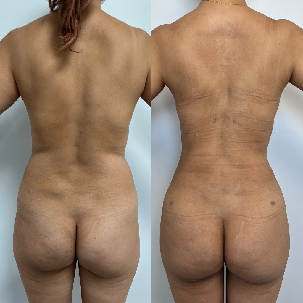 Lipoescultura o Liposucción – foto 7 | Dr. Diego Castañeda, cirujano plástico en Neiva