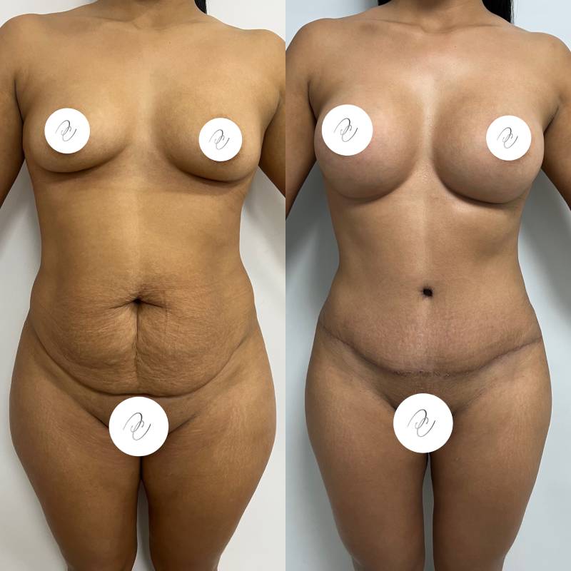 Abdominoplastia o lipectomía – foto 5 | Dr. Diego Castañeda, cirujano plástico en Neiva