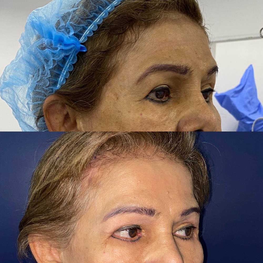 Frontoplastia – foto 2 | Dr. Diego Castañeda, cirujano plástico en Neiva