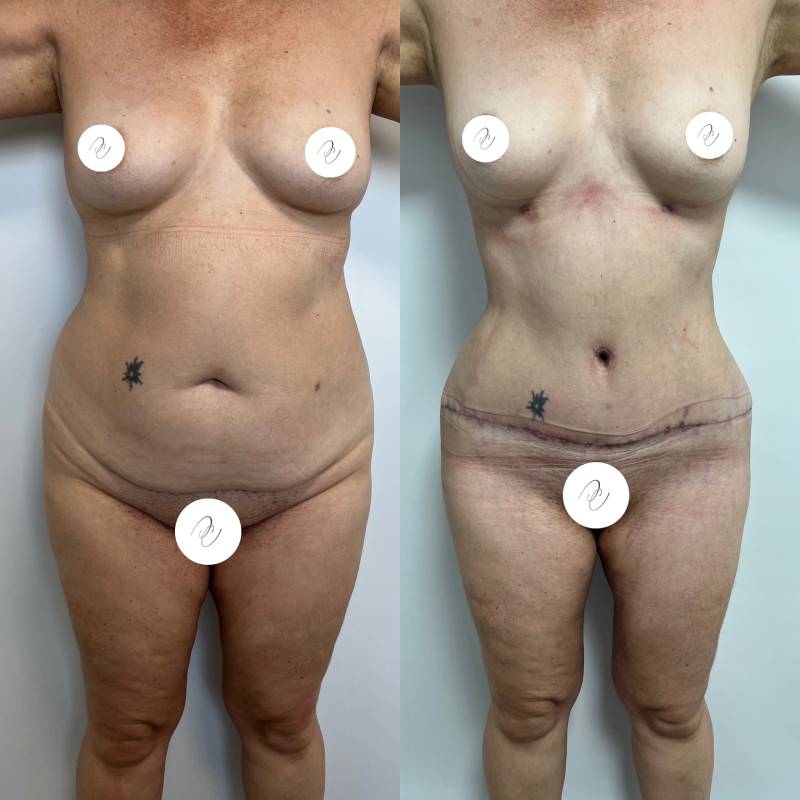 Abdominoplastia o lipectomía – foto 4 | Dr. Diego Castañeda, cirujano plástico en Neiva