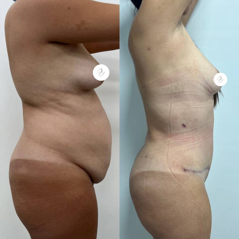 Abdominoplastia o lipectomía – foto 3 | Dr. Diego Castañeda, cirujano plástico en Neiva