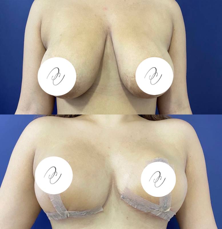 Mamoplastia de reducción – foto 1 | Dr. Diego Castañeda, cirujano plástico en Neiva