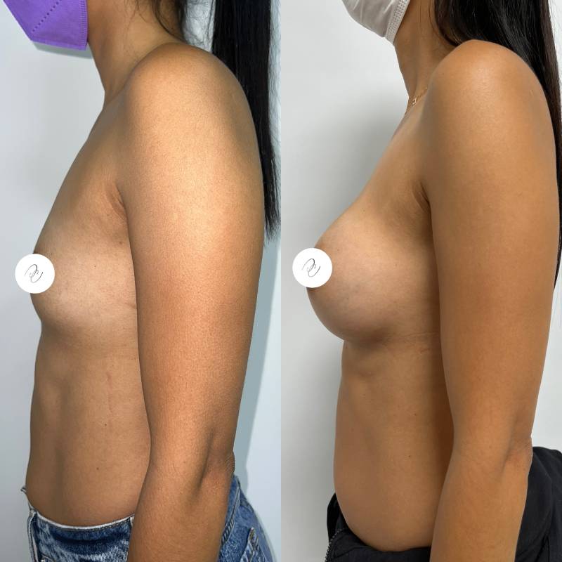 Mamoplastia – foto 4 | Dr. Diego Castañeda, cirujano plástico en Neiva