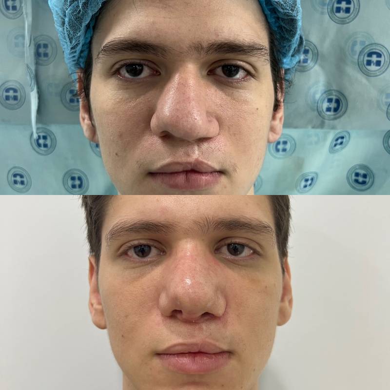 Reconstrucción nasal con injerto de costilla – foto 2 | Dr. Diego Castañeda, cirujano plástico en Neiva