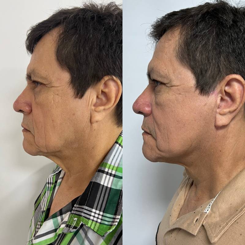 Ritidoplastia o lifting facial – foto 4 | Dr. Diego Castañeda, cirujano plástico en Neiva