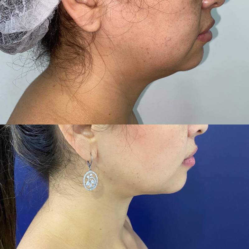 Liposucción de papada o de región submandibular – foto 1 | Dr. Diego Castañeda, cirujano plástico en Neiva