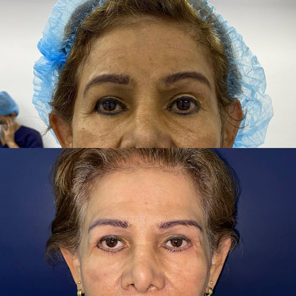 Frontoplastia – foto 3 | Dr. Diego Castañeda, cirujano plástico en Neiva