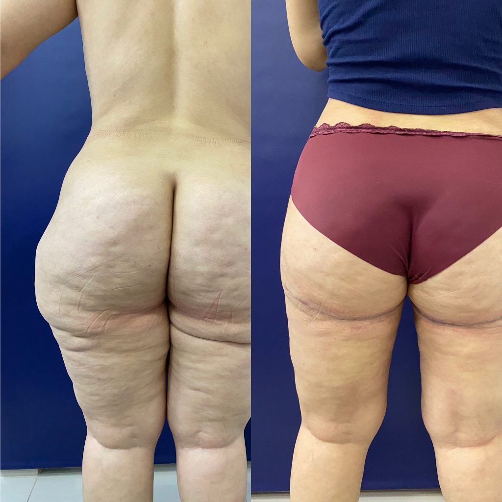 Levantamiento de muslos o cruroplastia – foto 1 | Dr. Diego Castañeda, cirujano plástico en Neiva