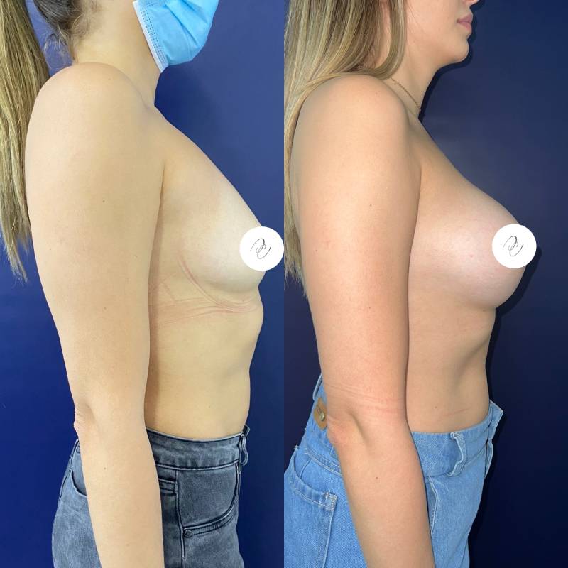 Mamoplastia – foto 7 | Dr. Diego Castañeda, cirujano plástico en Neiva