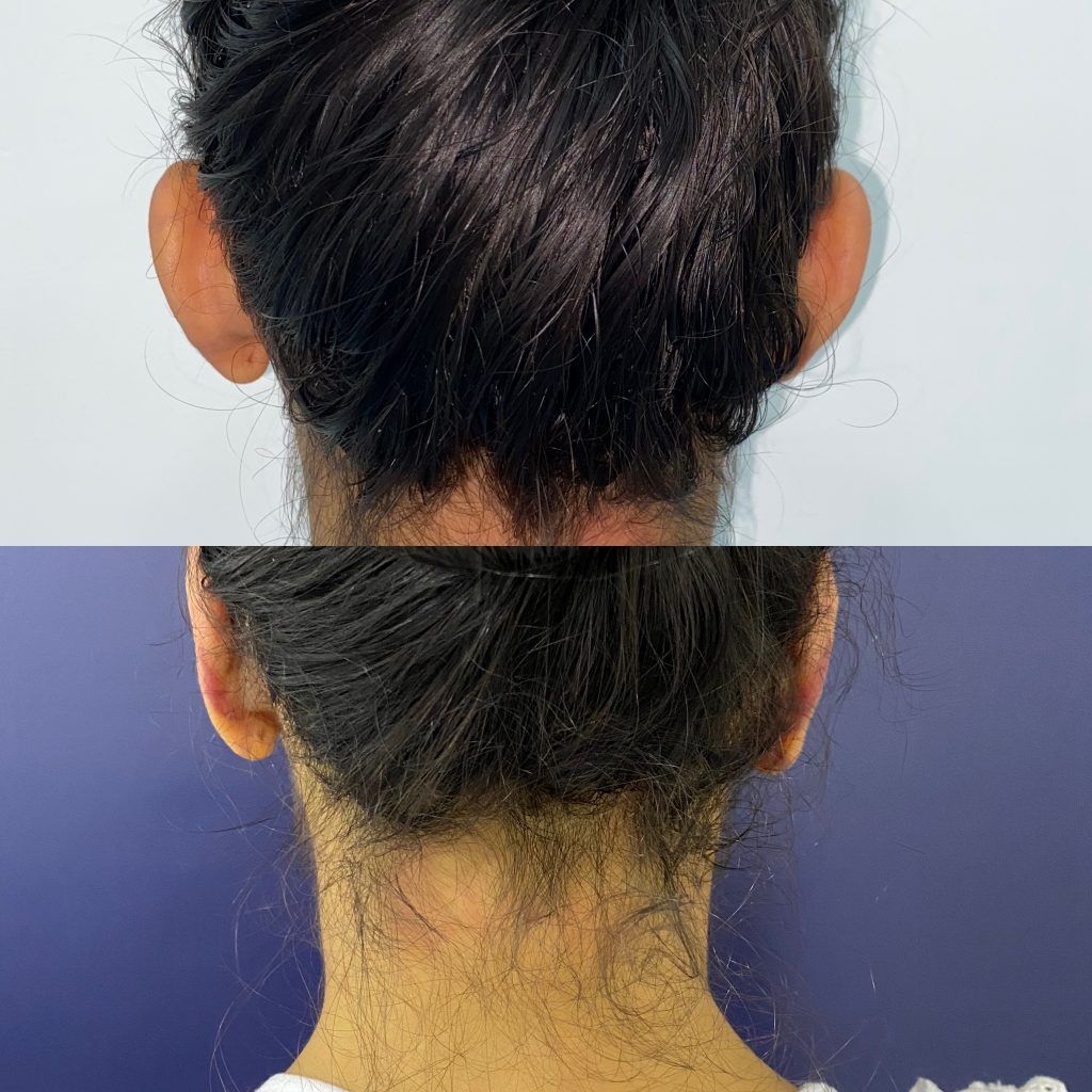 Otoplastia o Cirugía de Orejas – foto 5 | Dr. Diego Castañeda, cirujano plástico en Neiva