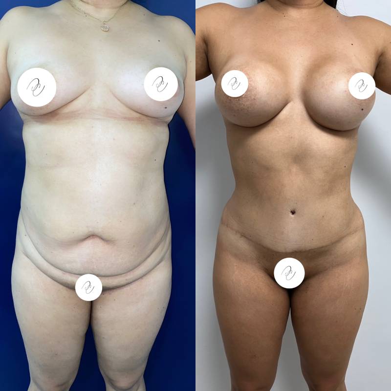 Abdominoplastia o lipectomía – foto 2 | Dr. Diego Castañeda, cirujano plástico en Neiva