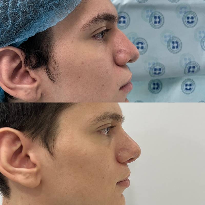 Reconstrucción nasal con injerto de costilla – foto 1 | Dr. Diego Castañeda, cirujano plástico en Neiva