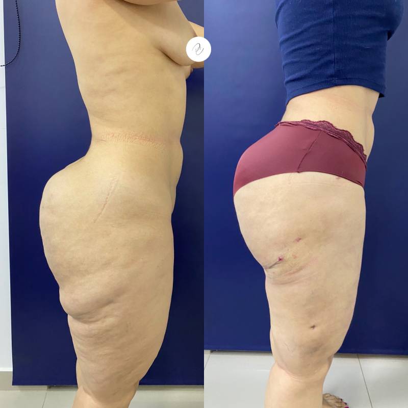 Levantamiento de muslos o cruroplastia – foto 2 | Dr. Diego Castañeda, cirujano plástico en Neiva