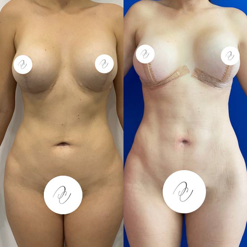 Lipoescultura o Liposucción – foto 5 | Dr. Diego Castañeda, cirujano plástico en Neiva