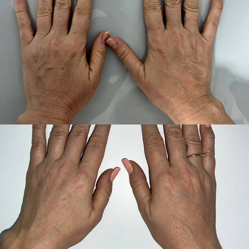 Aplicación de Radiesse/Sculptra | Dr. Diego Castañeda, cirujano plástico en Neiva