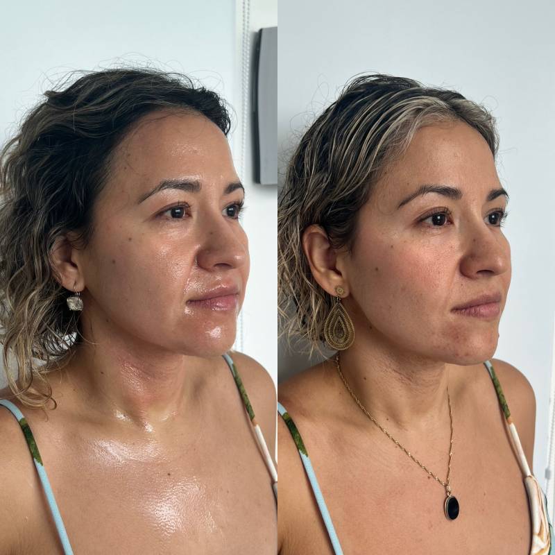 Radiofrecuencia por Microagujas – foto 2 | Dr. Diego Castañeda, cirujano plástico en Neiva