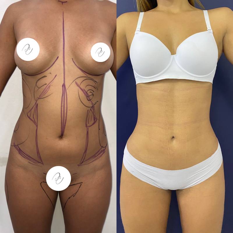 Lipoescultura o Liposucción – foto 3 | Dr. Diego Castañeda, cirujano plástico en Neiva