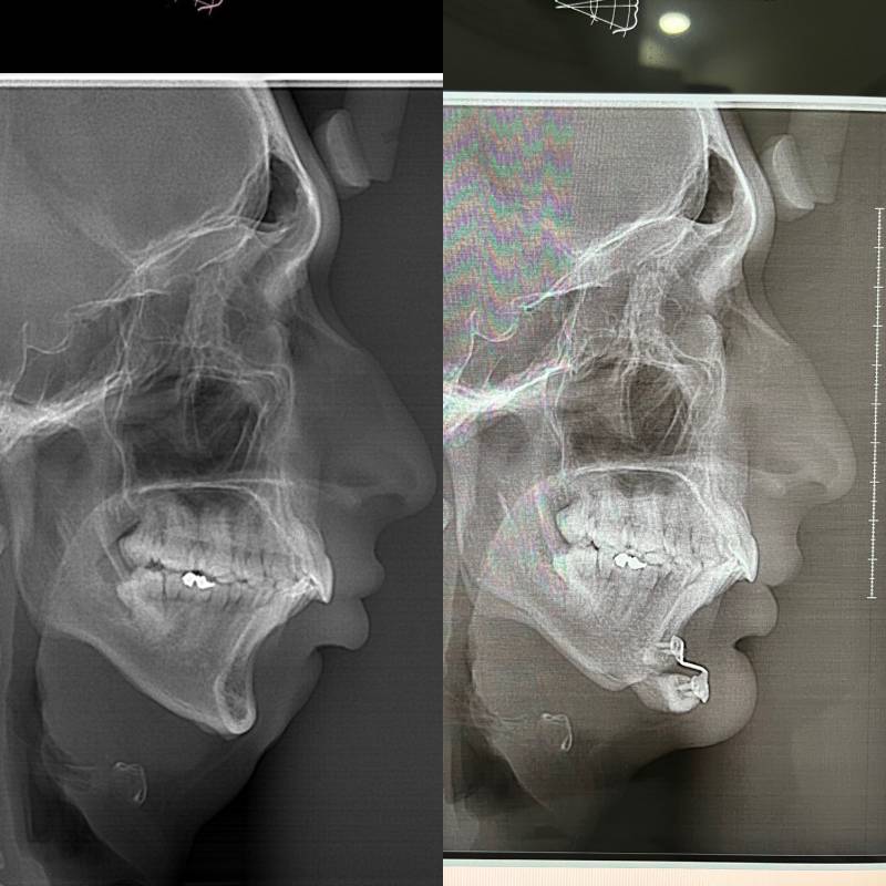 Mentoplastia – foto 3 | Dr. Diego Castañeda, cirujano plástico en Neiva