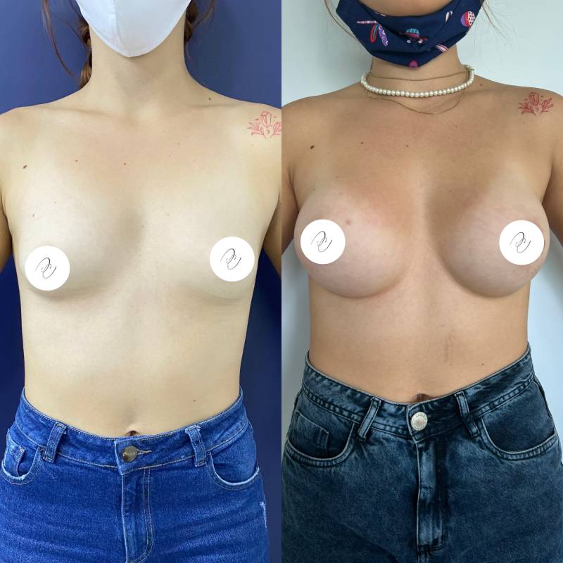 Mamoplastia – foto 5 | Dr. Diego Castañeda, cirujano plástico en Neiva