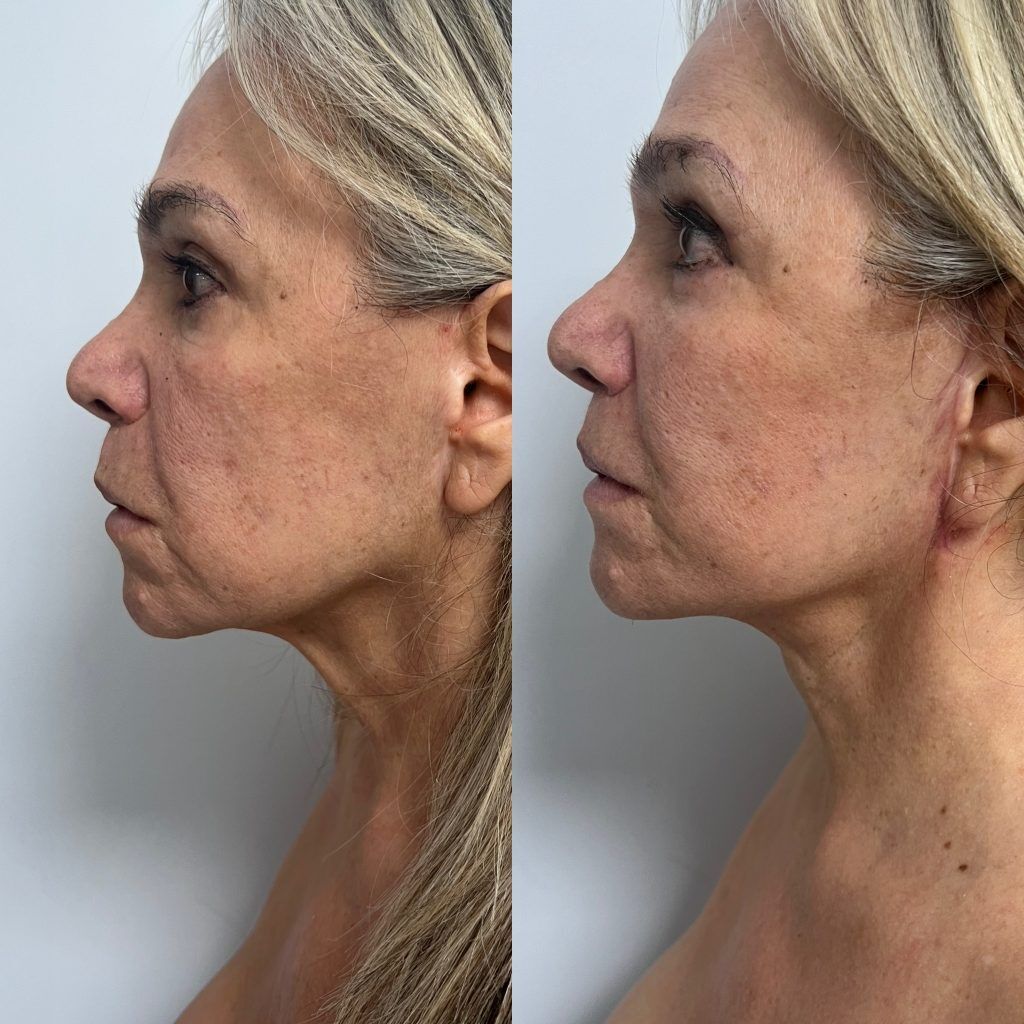 Ritidoplastia o lifting facial – foto 1 | Dr. Diego Castañeda, cirujano plástico en Neiva