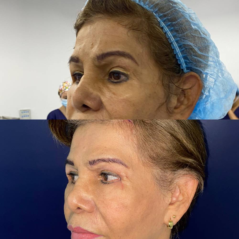 Frontoplastia – foto 1 | Dr. Diego Castañeda, cirujano plástico en Neiva