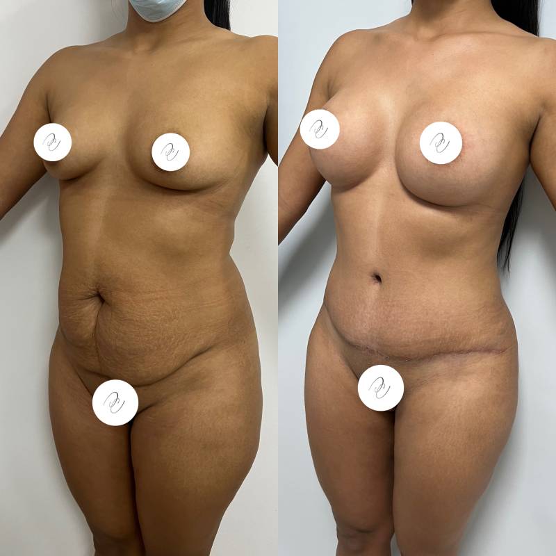 Rejuvenecimiento Corporal Post-Parto (Mommy Makeover) – foto 1 | Dr. Diego Castañeda, cirujano plástico en Neiva